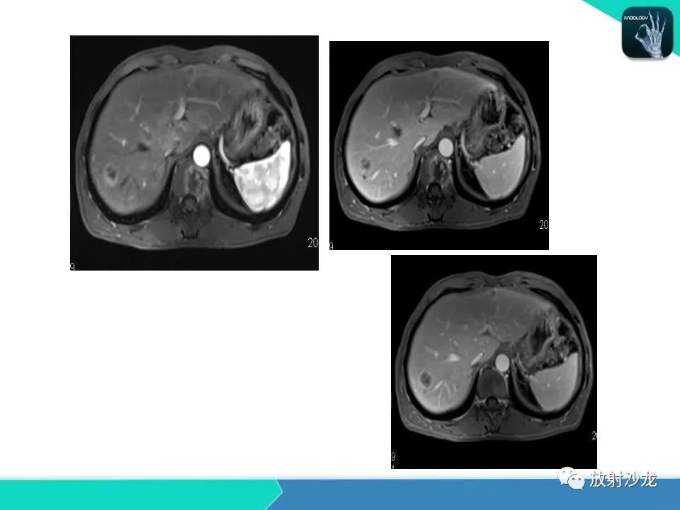 【PPT】肝脏孤立性坏死结节的CT、MRI诊断及鉴别诊断