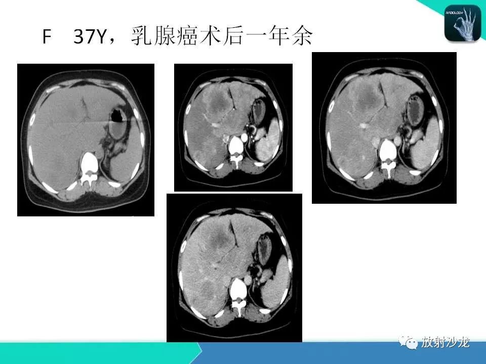 【PPT】肝脏孤立性坏死结节的CT、MRI诊断及鉴别诊断