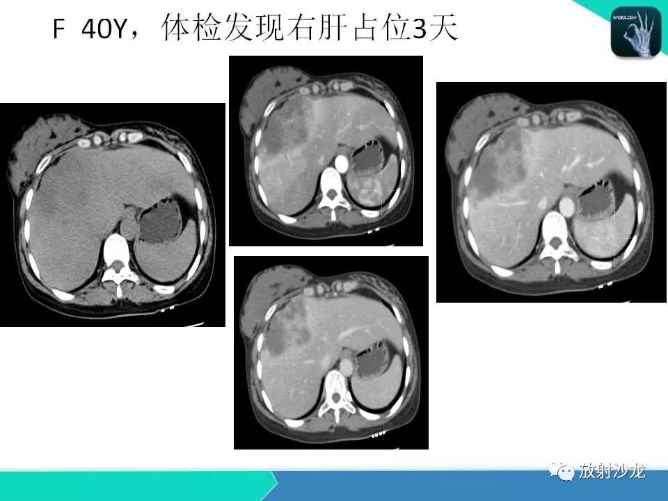 【PPT】肝脏孤立性坏死结节的CT、MRI诊断及鉴别诊断