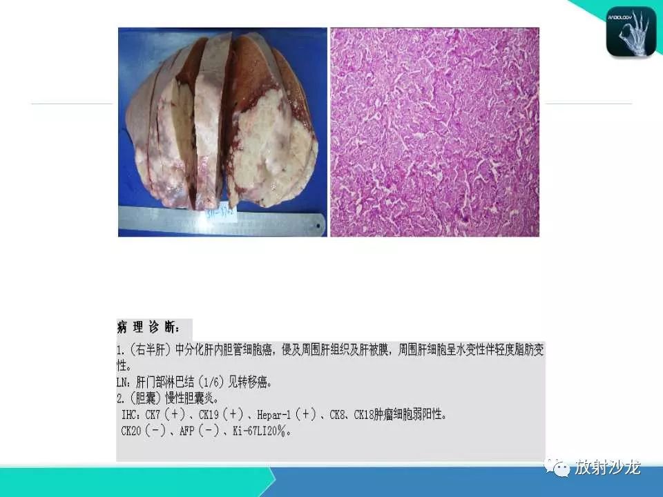 【PPT】肝脏孤立性坏死结节的CT、MRI诊断及鉴别诊断
