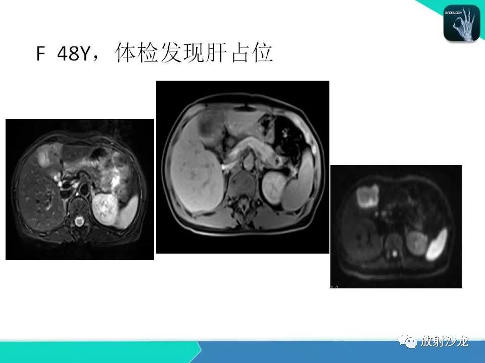 【PPT】肝脏孤立性坏死结节的CT、MRI诊断及鉴别诊断