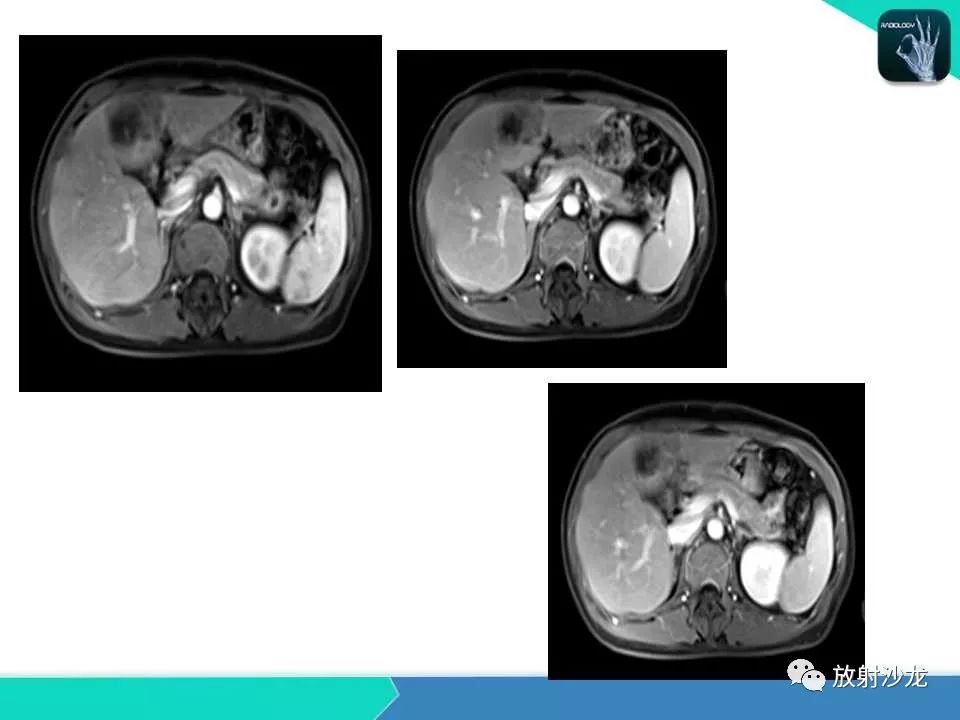 【PPT】肝脏孤立性坏死结节的CT、MRI诊断及鉴别诊断
