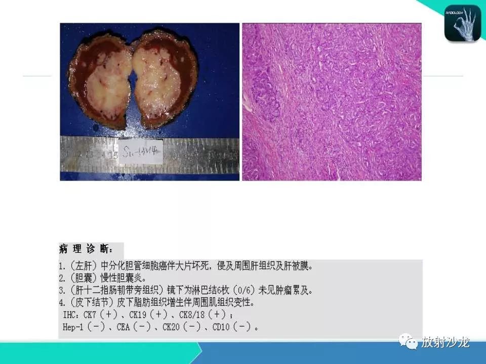 【PPT】肝脏孤立性坏死结节的CT、MRI诊断及鉴别诊断