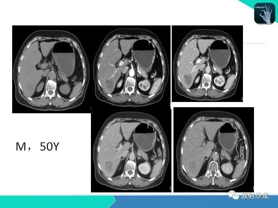 【PPT】肝脏孤立性坏死结节的CT、MRI诊断及鉴别诊断
