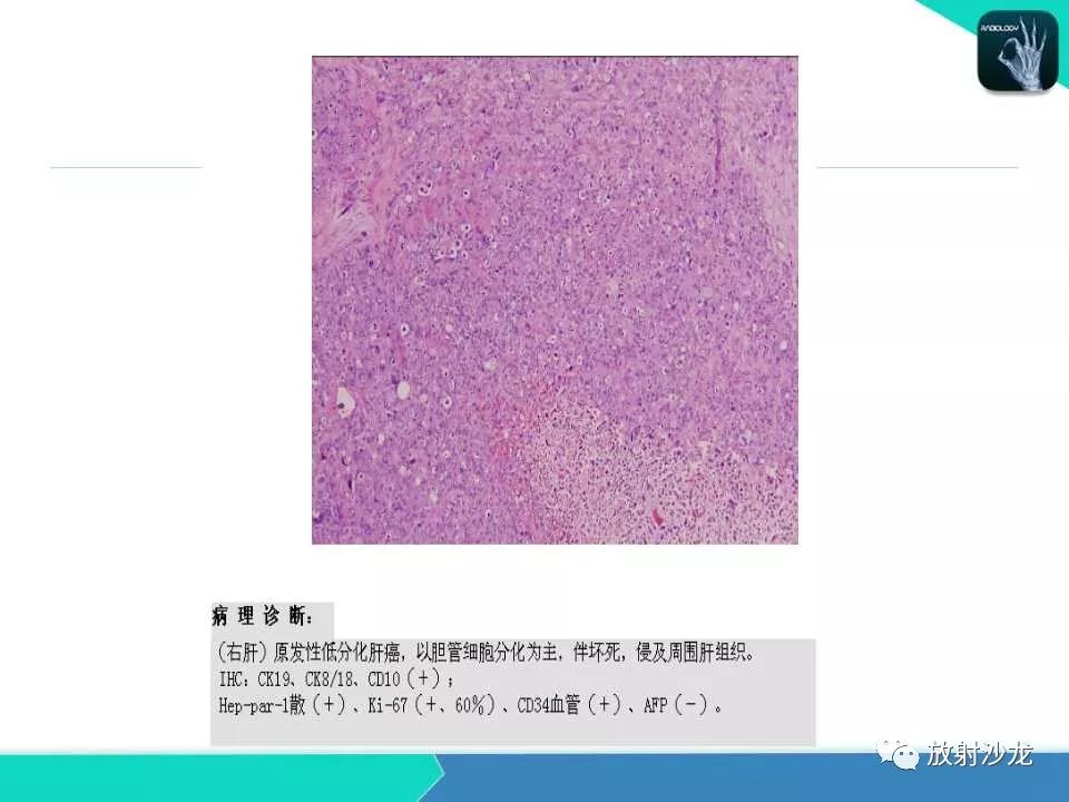 【PPT】肝脏孤立性坏死结节的CT、MRI诊断及鉴别诊断