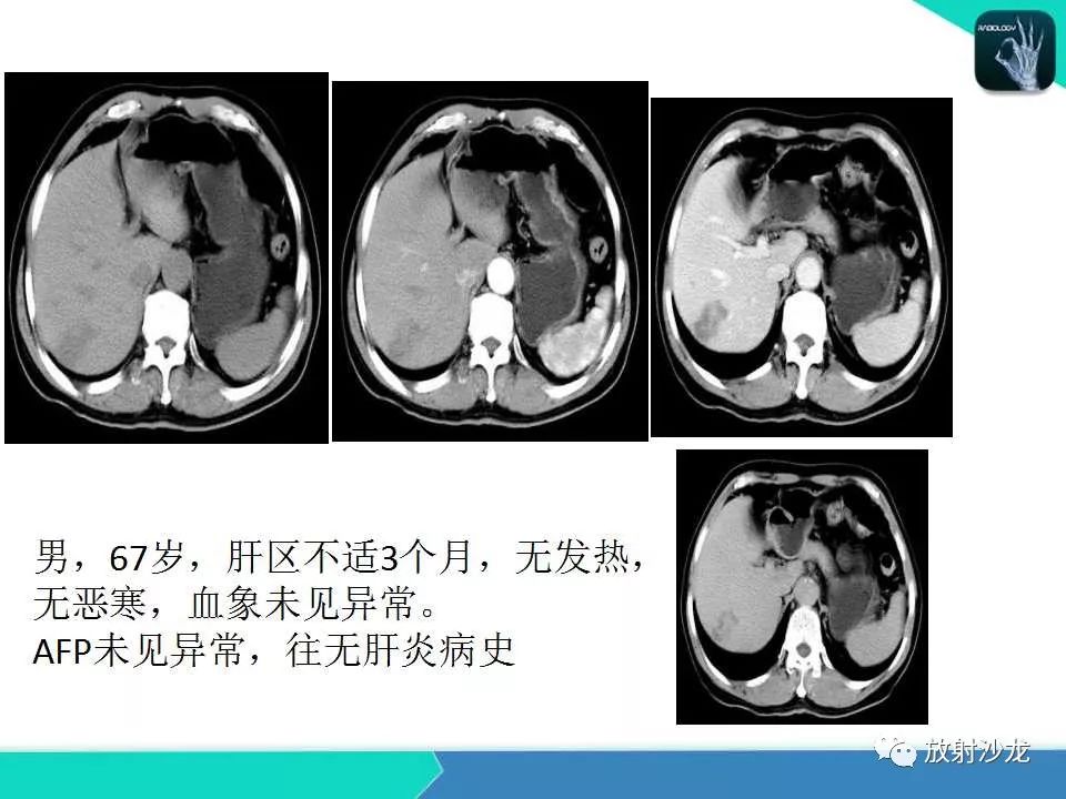 【PPT】肝脏孤立性坏死结节的CT、MRI诊断及鉴别诊断