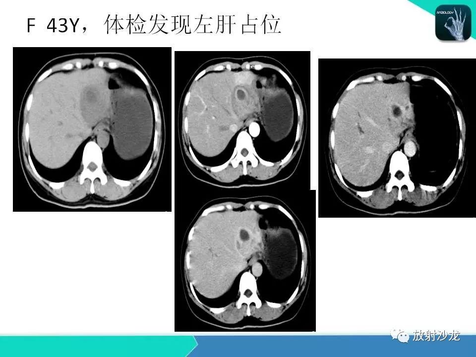 【PPT】肝脏孤立性坏死结节的CT、MRI诊断及鉴别诊断