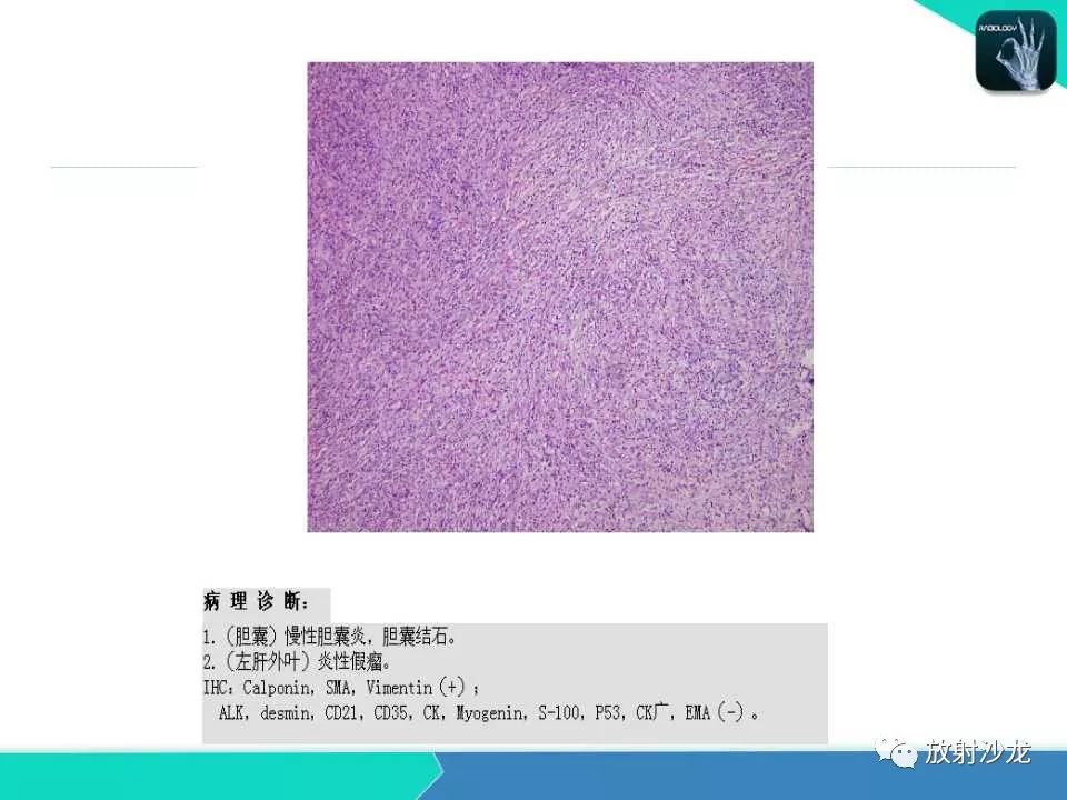 【PPT】肝脏孤立性坏死结节的CT、MRI诊断及鉴别诊断
