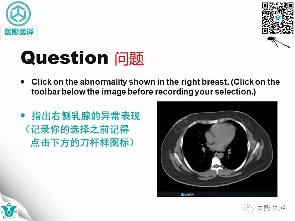 【病例】皮肌炎相关性乳腺钙质沉着症1例X线钼靶影像表现