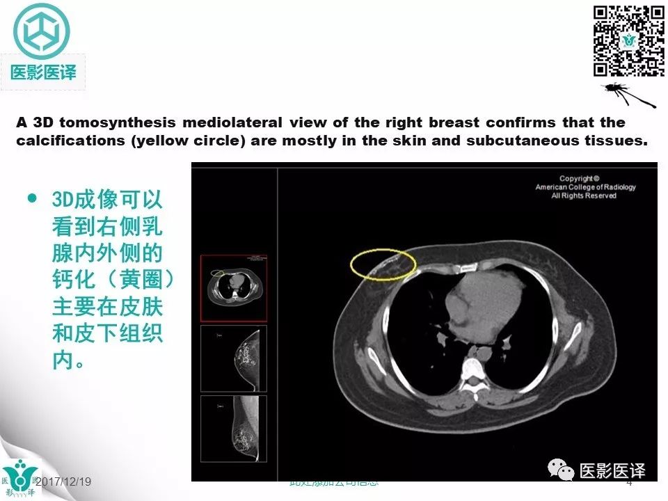 【病例】皮肌炎相关性乳腺钙质沉着症1例X线钼靶影像表现