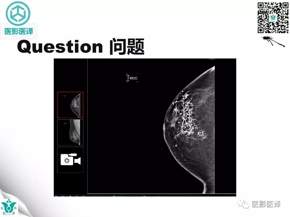 【病例】皮肌炎相关性乳腺钙质沉着症1例X线钼靶影像表现