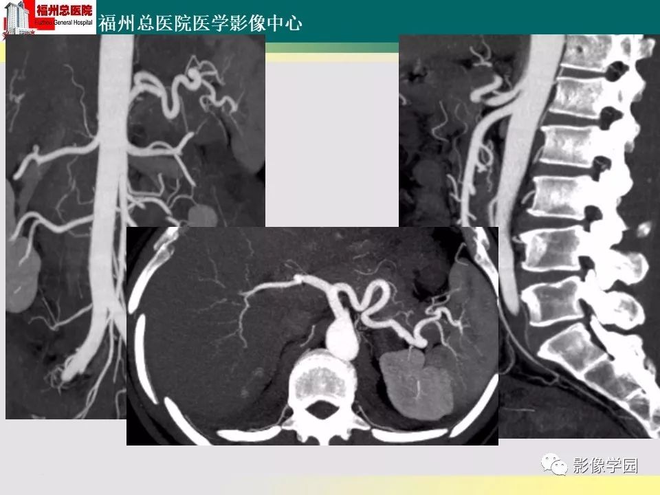 【PPT】256层螺旋CT血管成像技术在腹盆部血管压迫综合征诊断的应用 【PPT】256层螺旋CT血管成像技术在腹盆部血管压迫综合征诊断的应用