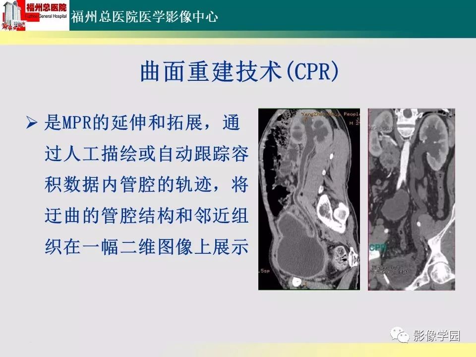 【PPT】256层螺旋CT血管成像技术在腹盆部血管压迫综合征诊断的应用 【PPT】256层螺旋CT血管成像技术在腹盆部血管压迫综合征诊断的应用