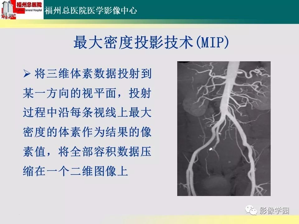 【PPT】256层螺旋CT血管成像技术在腹盆部血管压迫综合征诊断的应用 【PPT】256层螺旋CT血管成像技术在腹盆部血管压迫综合征诊断的应用