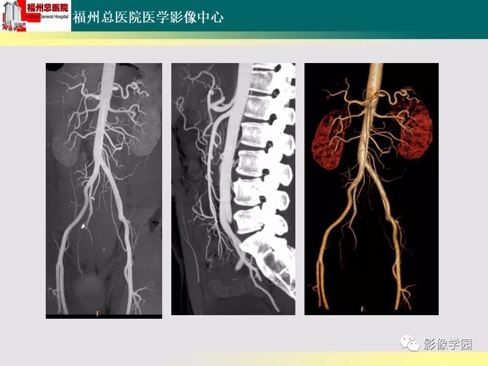 【PPT】256层螺旋CT血管成像技术在腹盆部血管压迫综合征诊断的应用 【PPT】256层螺旋CT血管成像技术在腹盆部血管压迫综合征诊断的应用