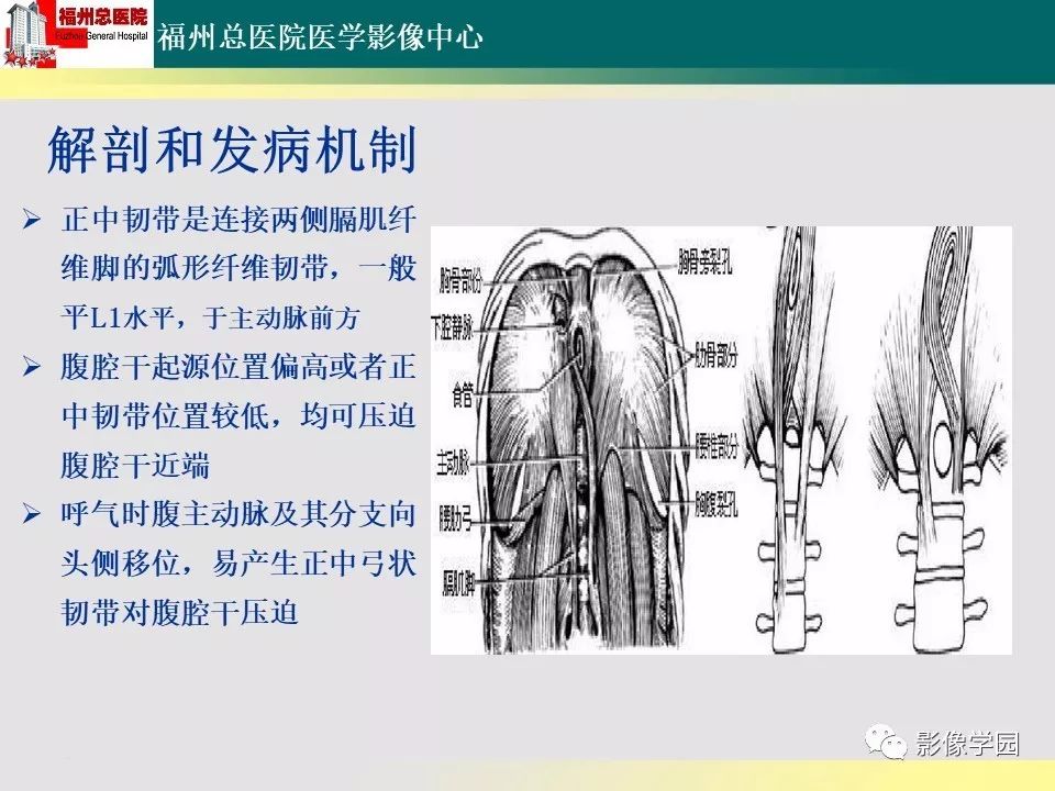 【PPT】256层螺旋CT血管成像技术在腹盆部血管压迫综合征诊断的应用 【PPT】256层螺旋CT血管成像技术在腹盆部血管压迫综合征诊断的应用