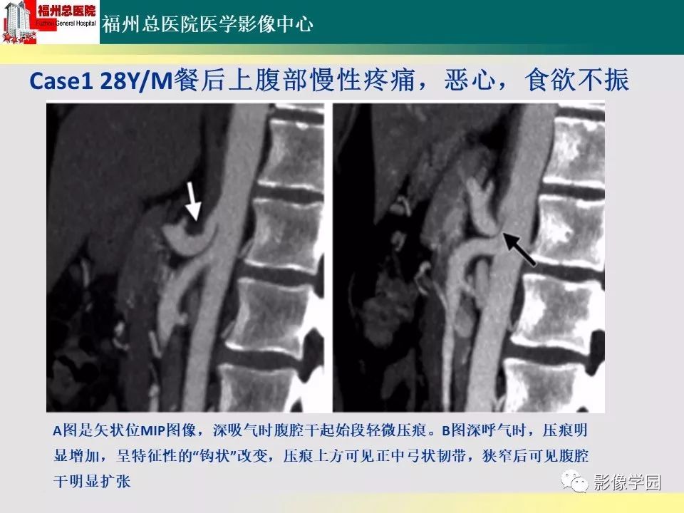 【PPT】256层螺旋CT血管成像技术在腹盆部血管压迫综合征诊断的应用 【PPT】256层螺旋CT血管成像技术在腹盆部血管压迫综合征诊断的应用