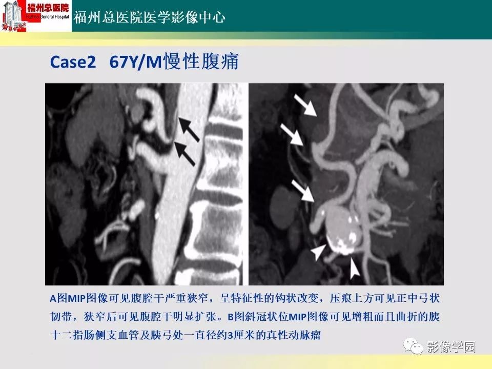 【PPT】256层螺旋CT血管成像技术在腹盆部血管压迫综合征诊断的应用 【PPT】256层螺旋CT血管成像技术在腹盆部血管压迫综合征诊断的应用