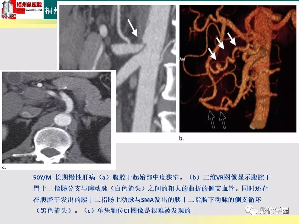 【PPT】256层螺旋CT血管成像技术在腹盆部血管压迫综合征诊断的应用 【PPT】256层螺旋CT血管成像技术在腹盆部血管压迫综合征诊断的应用