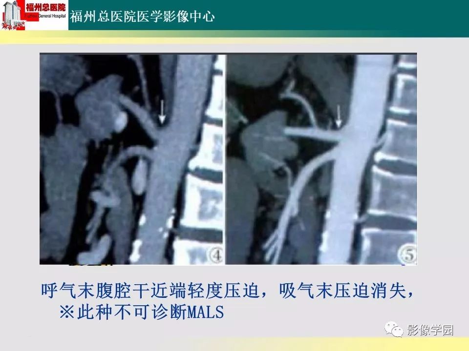 【PPT】256层螺旋CT血管成像技术在腹盆部血管压迫综合征诊断的应用 【PPT】256层螺旋CT血管成像技术在腹盆部血管压迫综合征诊断的应用