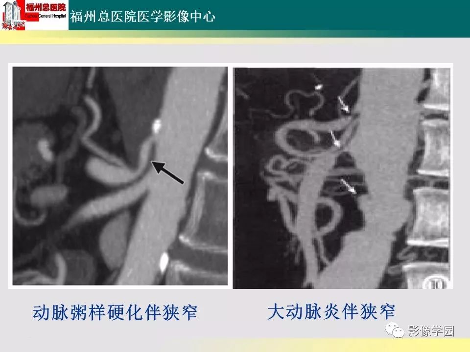 【PPT】256层螺旋CT血管成像技术在腹盆部血管压迫综合征诊断的应用 【PPT】256层螺旋CT血管成像技术在腹盆部血管压迫综合征诊断的应用