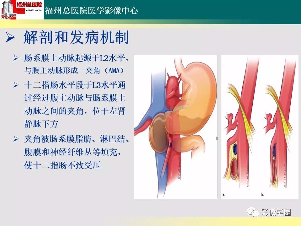 【PPT】256层螺旋CT血管成像技术在腹盆部血管压迫综合征诊断的应用 【PPT】256层螺旋CT血管成像技术在腹盆部血管压迫综合征诊断的应用