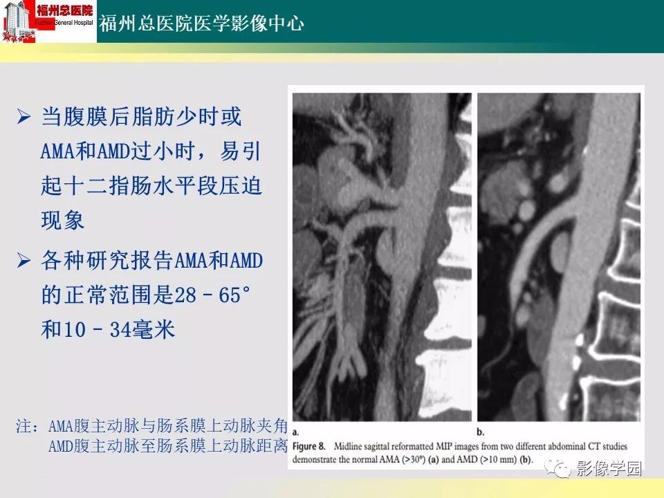 【PPT】256层螺旋CT血管成像技术在腹盆部血管压迫综合征诊断的应用 【PPT】256层螺旋CT血管成像技术在腹盆部血管压迫综合征诊断的应用
