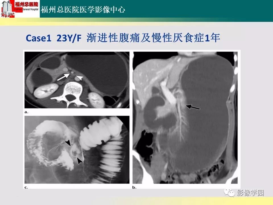 【PPT】256层螺旋CT血管成像技术在腹盆部血管压迫综合征诊断的应用 【PPT】256层螺旋CT血管成像技术在腹盆部血管压迫综合征诊断的应用