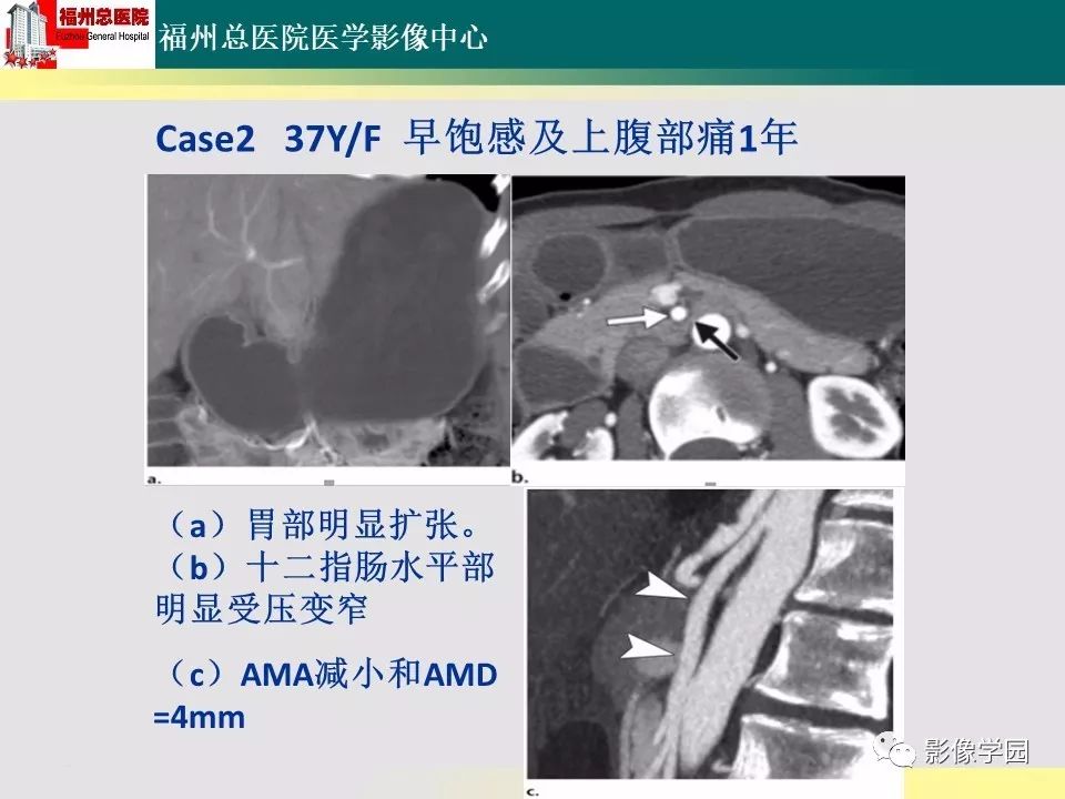 【PPT】256层螺旋CT血管成像技术在腹盆部血管压迫综合征诊断的应用 【PPT】256层螺旋CT血管成像技术在腹盆部血管压迫综合征诊断的应用