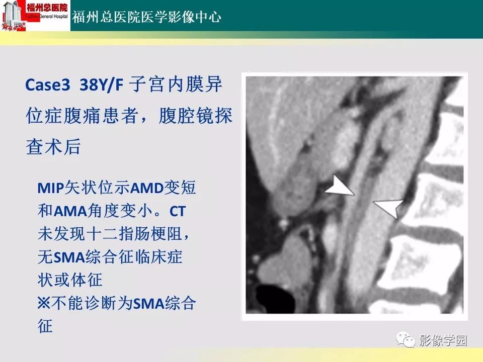 【PPT】256层螺旋CT血管成像技术在腹盆部血管压迫综合征诊断的应用 【PPT】256层螺旋CT血管成像技术在腹盆部血管压迫综合征诊断的应用