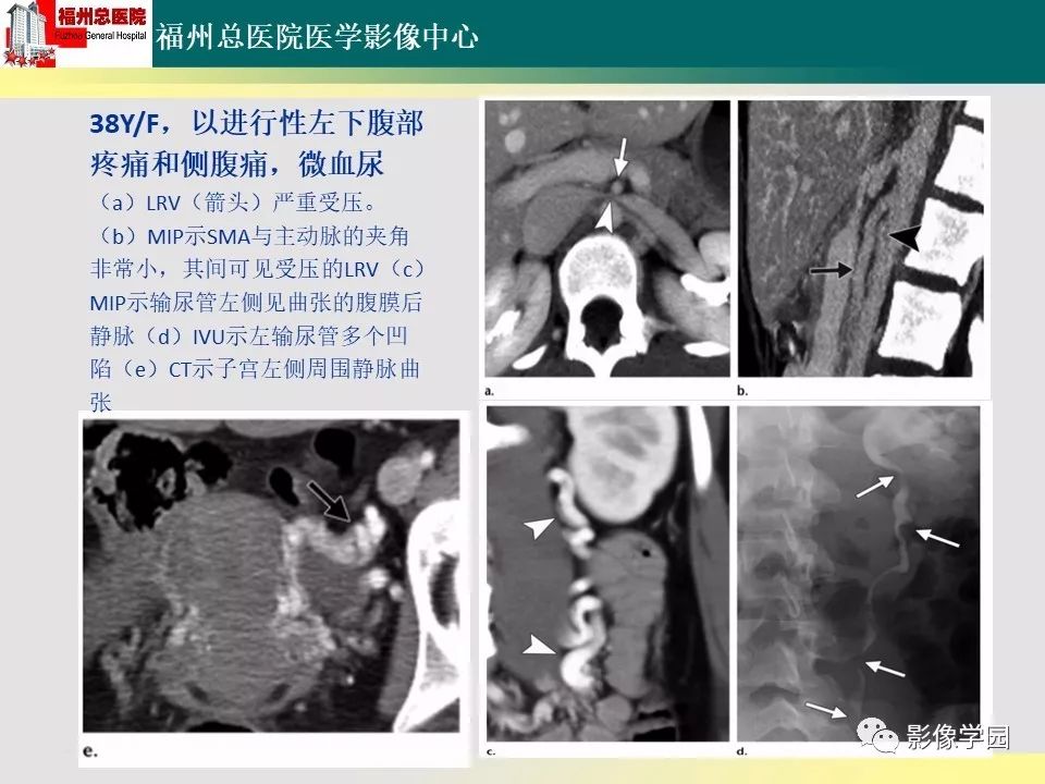 【PPT】256层螺旋CT血管成像技术在腹盆部血管压迫综合征诊断的应用 【PPT】256层螺旋CT血管成像技术在腹盆部血管压迫综合征诊断的应用