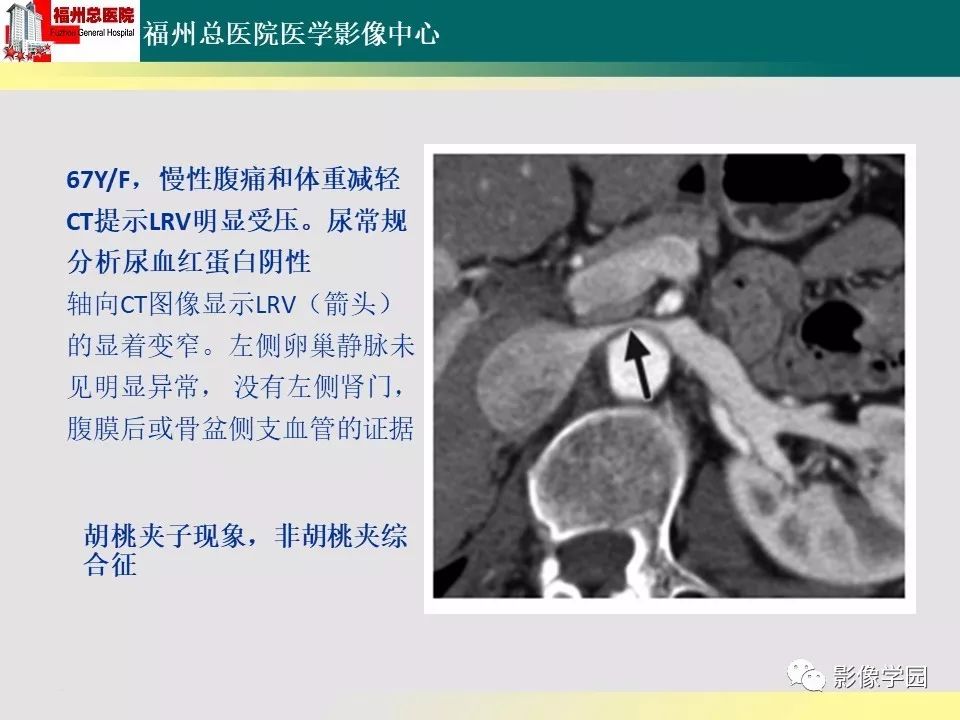 【PPT】256层螺旋CT血管成像技术在腹盆部血管压迫综合征诊断的应用 【PPT】256层螺旋CT血管成像技术在腹盆部血管压迫综合征诊断的应用
