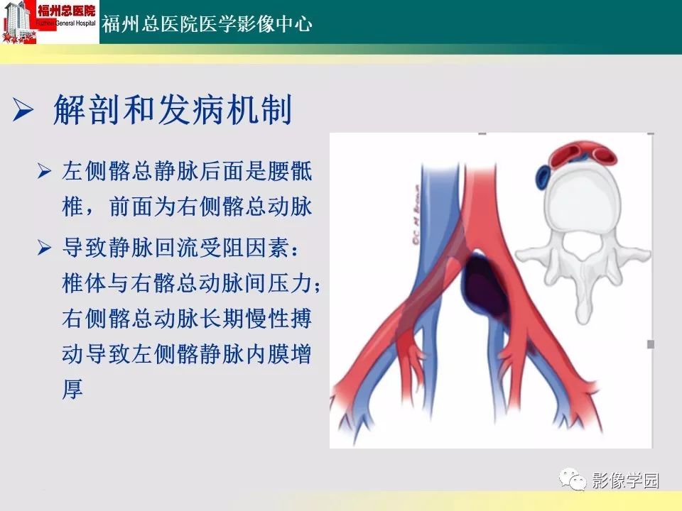 【PPT】256层螺旋CT血管成像技术在腹盆部血管压迫综合征诊断的应用 【PPT】256层螺旋CT血管成像技术在腹盆部血管压迫综合征诊断的应用