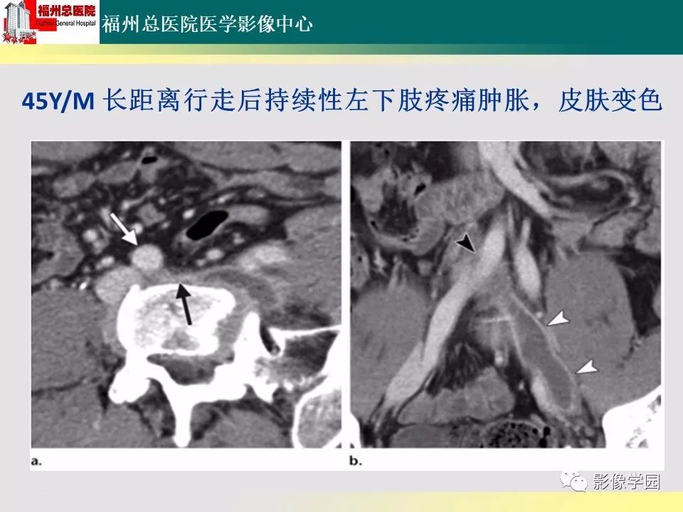 【PPT】256层螺旋CT血管成像技术在腹盆部血管压迫综合征诊断的应用 【PPT】256层螺旋CT血管成像技术在腹盆部血管压迫综合征诊断的应用