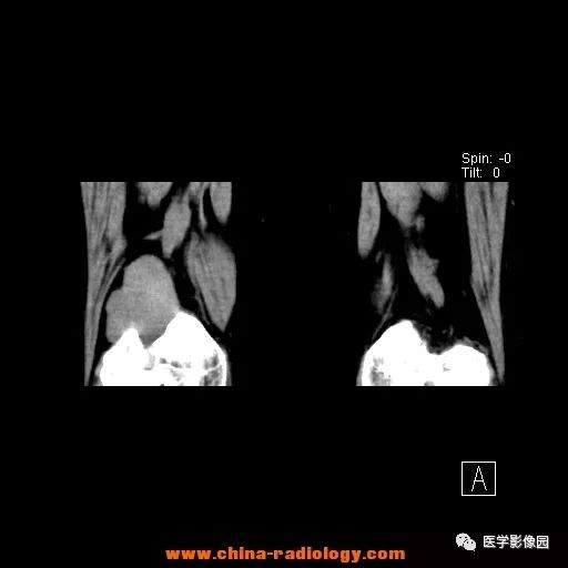 【病例】股骨下端梭形细胞瘤1例CT 【病例】股骨下端梭形细胞瘤1例CT