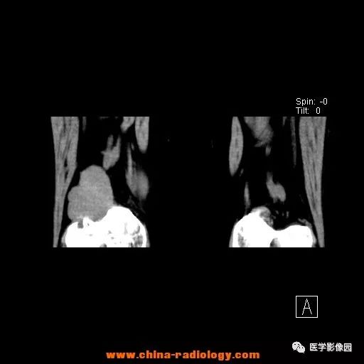 【病例】股骨下端梭形细胞瘤1例CT 【病例】股骨下端梭形细胞瘤1例CT