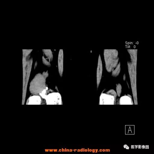 【病例】股骨下端梭形细胞瘤1例CT 【病例】股骨下端梭形细胞瘤1例CT