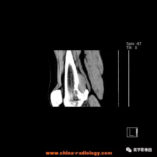 【病例】股骨下端梭形细胞瘤1例CT 【病例】股骨下端梭形细胞瘤1例CT