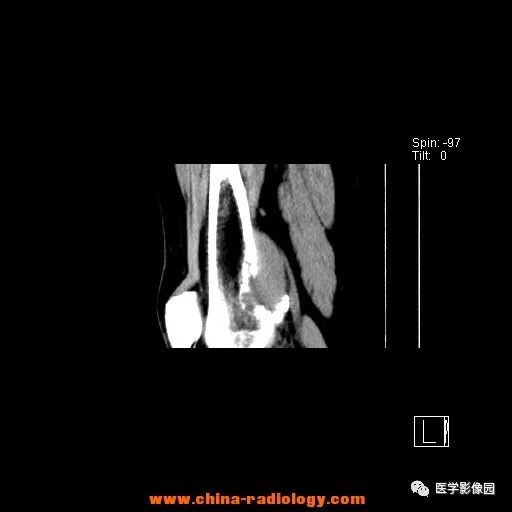 【病例】股骨下端梭形细胞瘤1例CT 【病例】股骨下端梭形细胞瘤1例CT