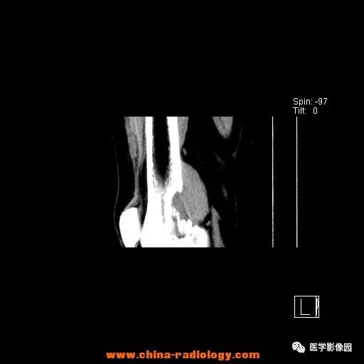 【病例】股骨下端梭形细胞瘤1例CT 【病例】股骨下端梭形细胞瘤1例CT