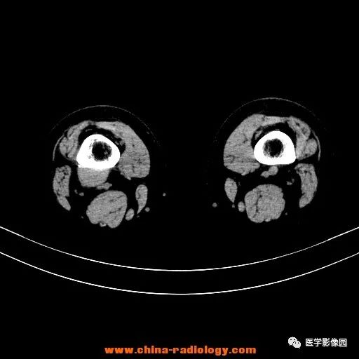 【病例】股骨下端梭形细胞瘤1例CT 【病例】股骨下端梭形细胞瘤1例CT