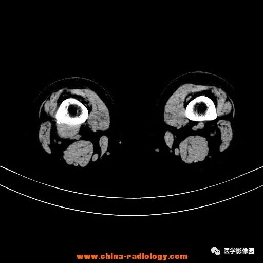 【病例】股骨下端梭形细胞瘤1例CT 【病例】股骨下端梭形细胞瘤1例CT