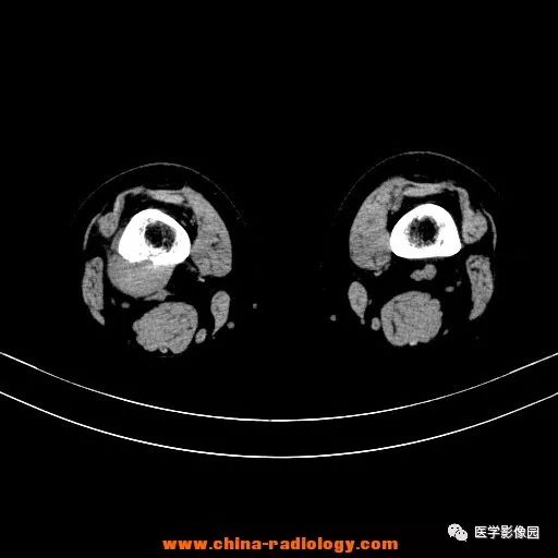 【病例】股骨下端梭形细胞瘤1例CT 【病例】股骨下端梭形细胞瘤1例CT