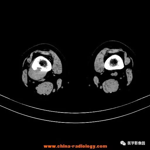 【病例】股骨下端梭形细胞瘤1例CT 【病例】股骨下端梭形细胞瘤1例CT