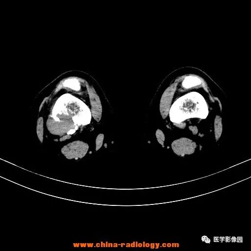 【病例】股骨下端梭形细胞瘤1例CT 【病例】股骨下端梭形细胞瘤1例CT