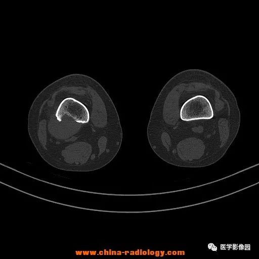 【病例】股骨下端梭形细胞瘤1例CT 【病例】股骨下端梭形细胞瘤1例CT