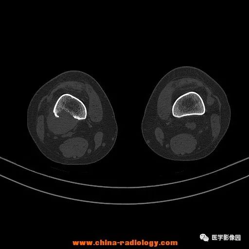 【病例】股骨下端梭形细胞瘤1例CT 【病例】股骨下端梭形细胞瘤1例CT