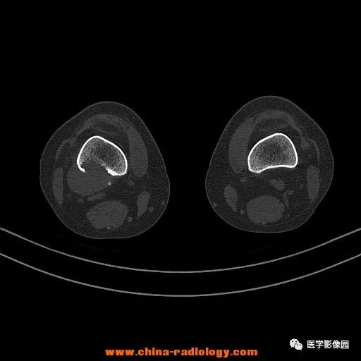 【病例】股骨下端梭形细胞瘤1例CT 【病例】股骨下端梭形细胞瘤1例CT