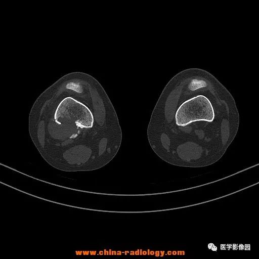 【病例】股骨下端梭形细胞瘤1例CT 【病例】股骨下端梭形细胞瘤1例CT