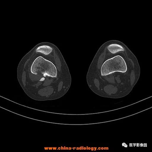 【病例】股骨下端梭形细胞瘤1例CT 【病例】股骨下端梭形细胞瘤1例CT